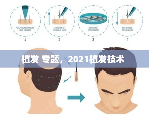 植发 专题,2021植发技术